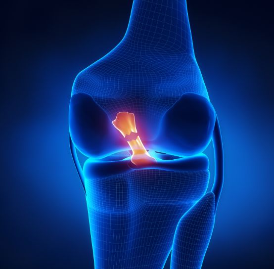 LESAO-DO-LIGAMENTO-CRUZADO-ANTERIOR-LCA